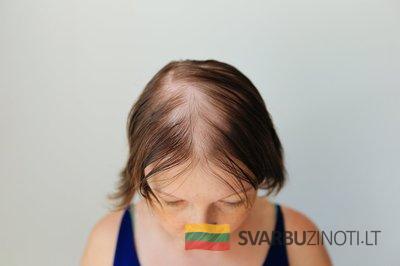 Išslinkę plaukai, asociatyvi nuotrauka